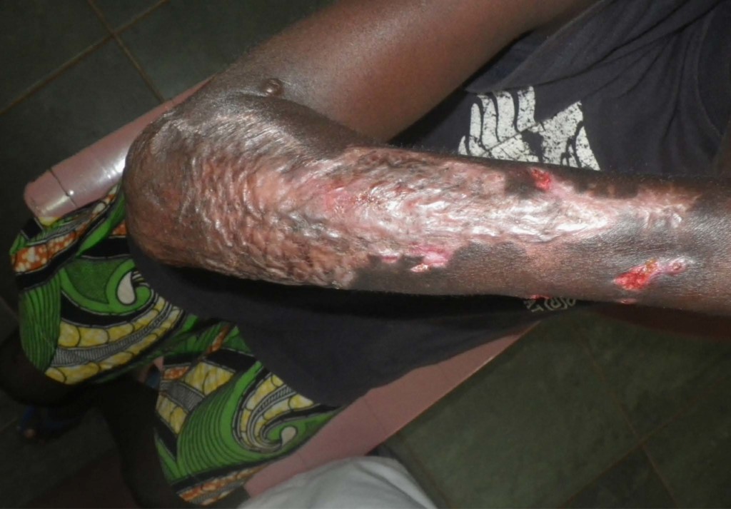 Buruli2