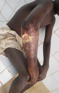 buruli1